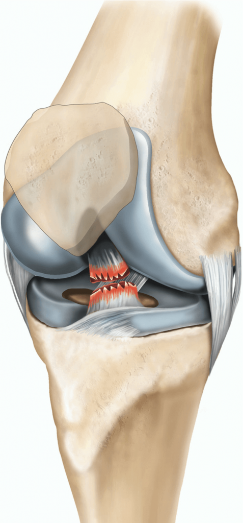 Chirurgie du Ligament Croisé Antérieur - CDR Chirurgie