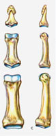 Arthrose du doigt