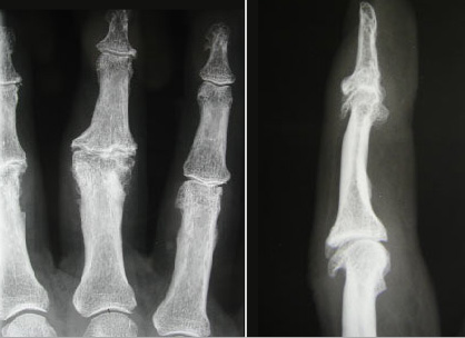 Arthrose du doigt 2